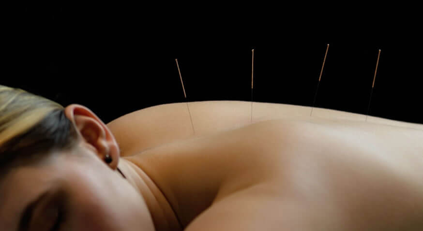 Acupuncture is for you